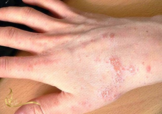 ۱۶ راهکار موثر برای درمان خانگی عفونت پوستی