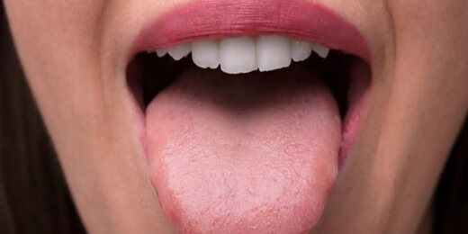 سوزش زبان نشانه چه بیماری‌هایی است؟