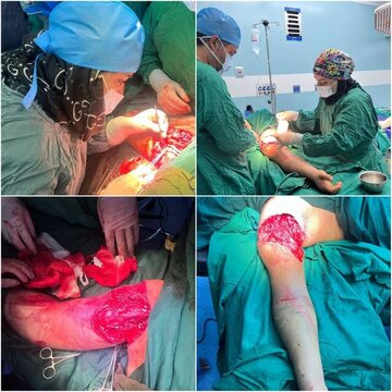 پیوند دست قطع‌ شده یک نوجوان در اردبیل