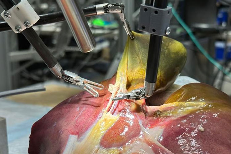 نخستین تجربه واقعی ربات جراح بدون کمک انسان