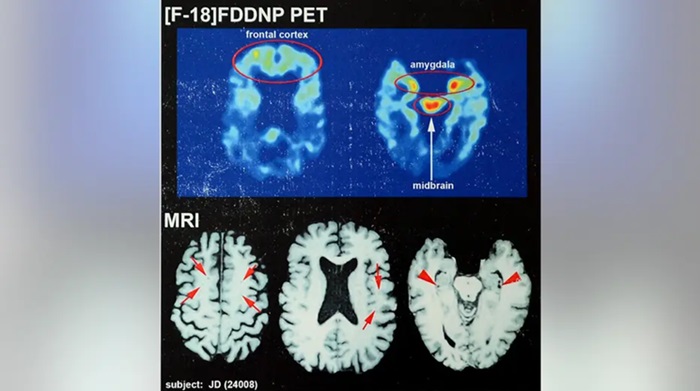 آسیب‌های ضربه‌های مکرر به سر در ورزشکاران: از التهاب تا نابودی سلول‌های مغز