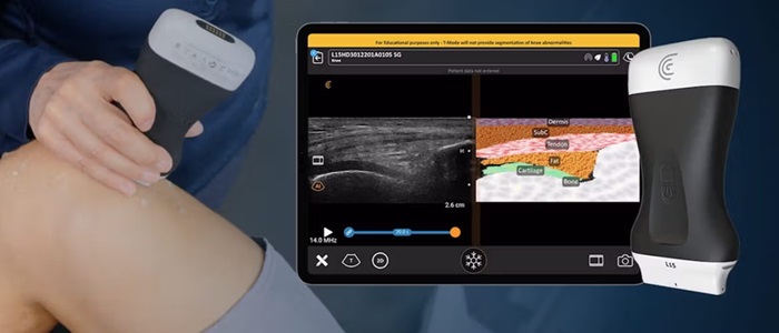 سونوگرافی بیسیم؛ انقلابی در ارزیابی آسیبهای ورزشی در میدان مسابقه