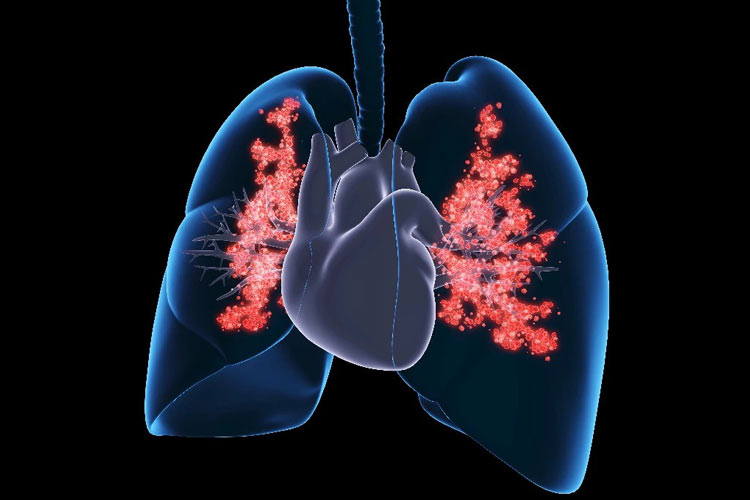 ۵ تأثیر مخرب تغییرات آب‌وهوایی بر سلامت ریه‌ها + راه‌های پیشگیری