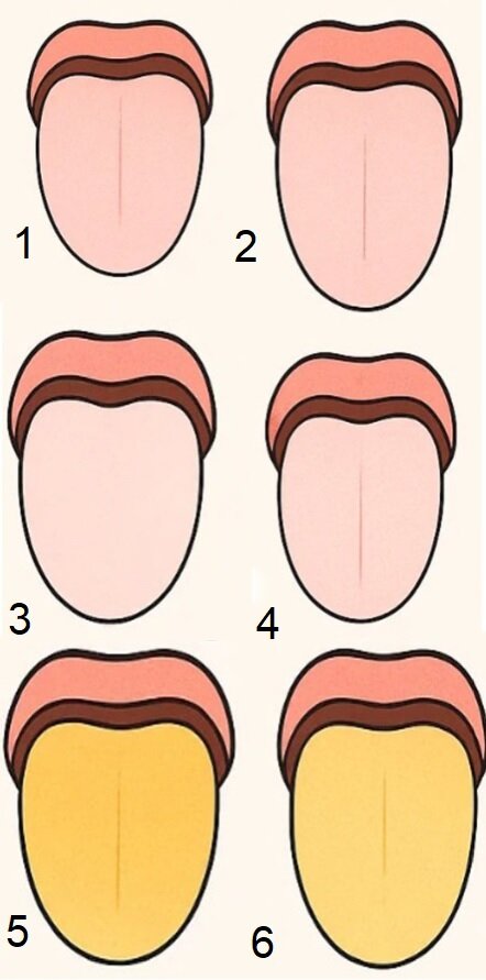 تشخیص انواع بیماری‌ها با بررسی زبان/ رد دندان روی زبان نشانه چیست؟