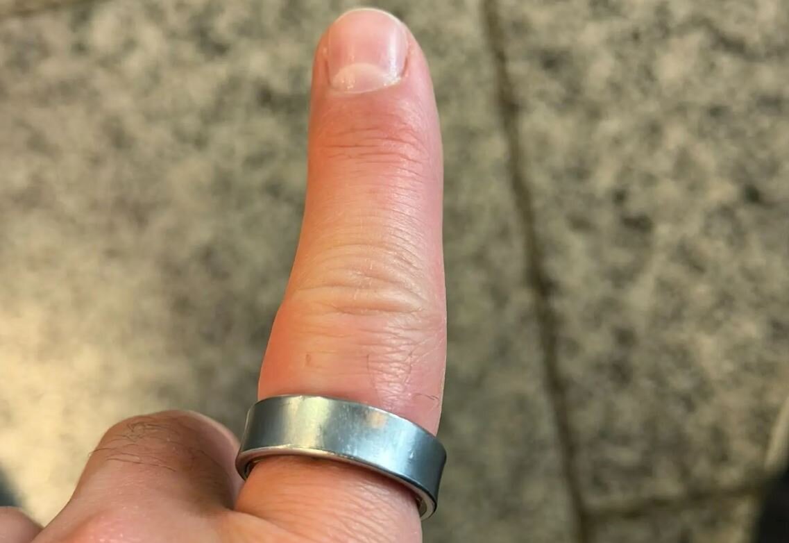 حلقه سامسونگ خطرناک شد / باتری ورم کرد و کار به بیمارستان کشیده شد