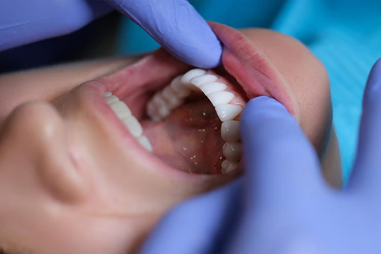 هشدار پزشکی: بیماری لثه، عامل پنهان سکته مغزی