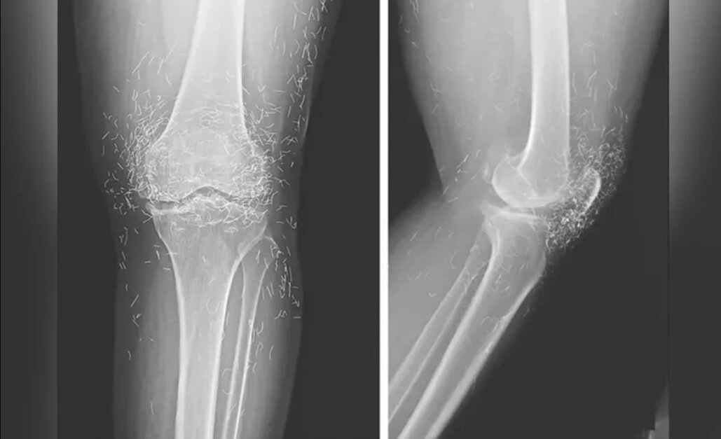 کشف صدها رشته طلای خالص در زانوی زن مبتلا به آرتروز