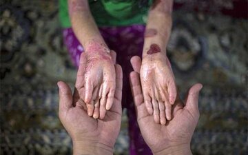 با خروج آمریکا از برجام، فوت مبتلایان به ‌ای‌بی به‌دلیل نداشتن پانسمان بیشتر شد/ برخی مدارس از ثبت‌نام این دانش‌آموزان خودداری می‌کنند