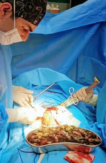 خروج ۹۰ بسته مواد مخدر از معده و روده یک بیمار/ عکس