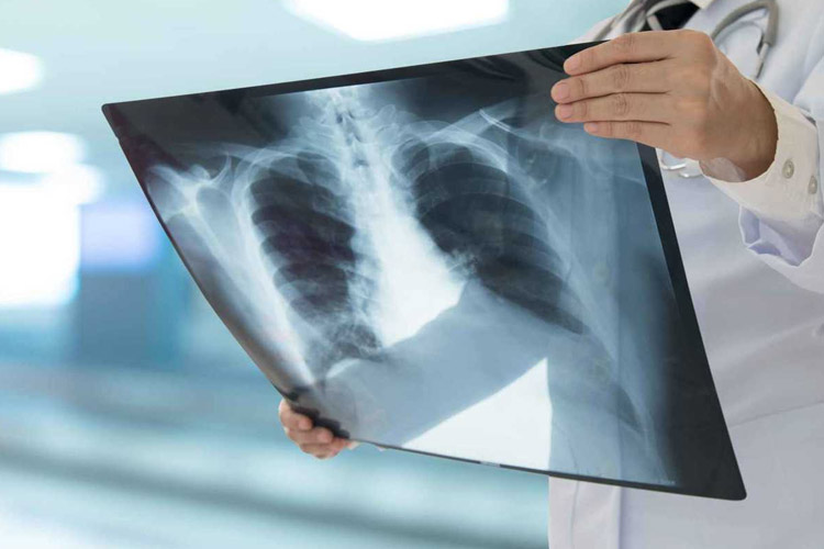 ارتباط رژیم غذایی و سرطان ریه: نقش حیاتی قند در رشد تومور