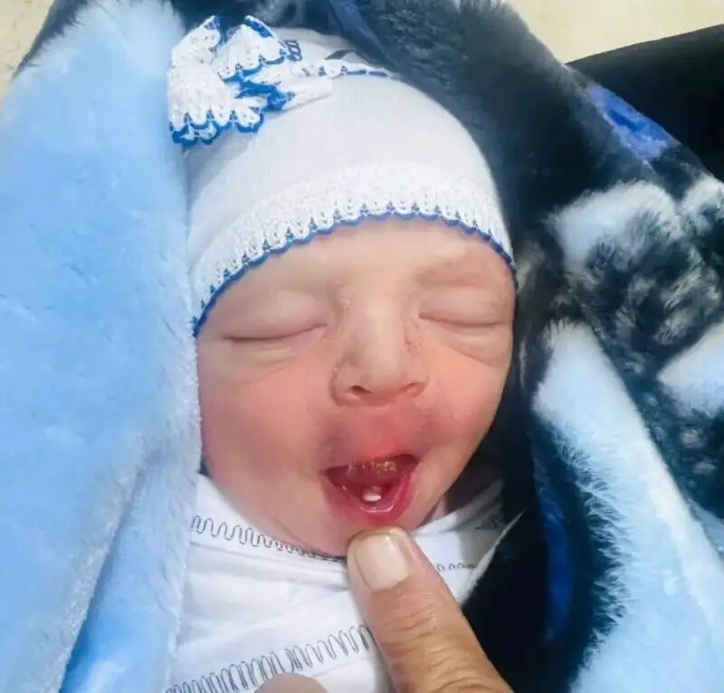 تولد یک نوزاد با دندان/ عکس