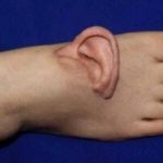 نجات لاله گوش زن چینی با پیوند موقت روی پا