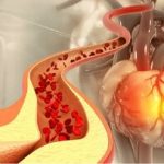 کاهش کلسترول، بدون نیاز به دارو/ چربیهای کاهنده کلسترول کدامند؟/ این ورزشها موثرند