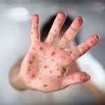 گزارش جدید سازمان جهانی بهداشت از شیوع سرخک