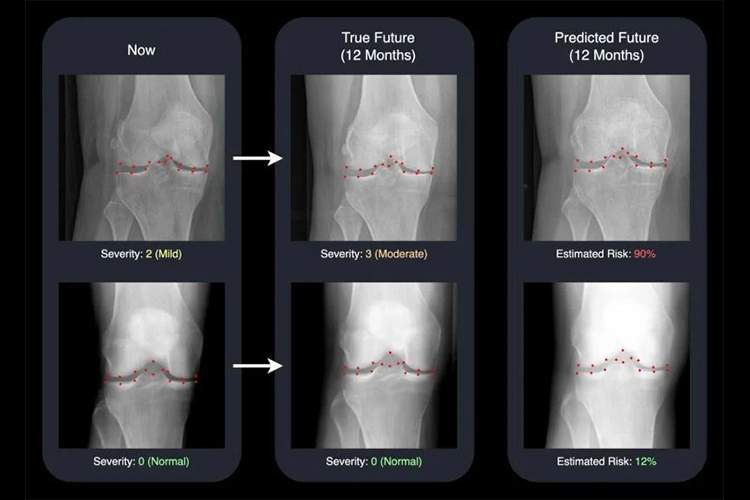 تشخیص زودهنگام آرتروز با هوش مصنوعی؛ تصویری از زانوی یک سال بعد