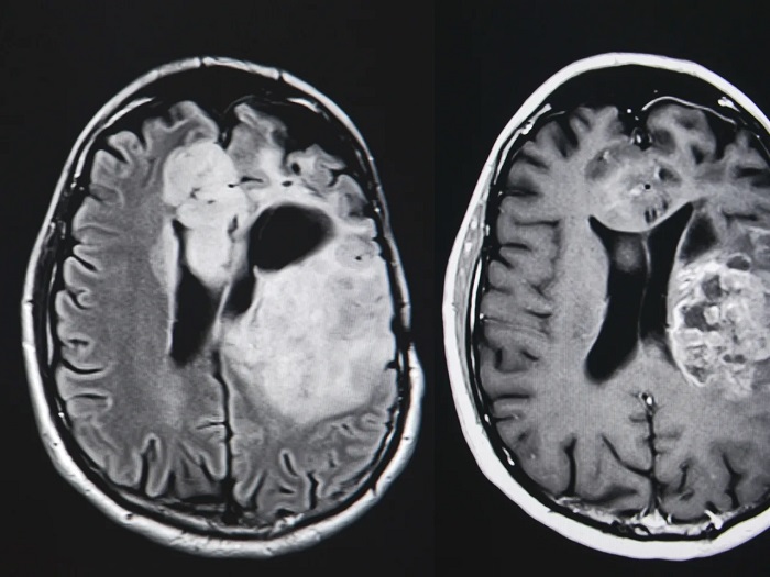 ویتامین B3؛ امید تازهای برای توقف رشد تومورهای مغزی خطرناک
