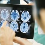 چه کسانی بیشتر در معرض خطر تومورهای مغزی هستند؟/ علائم هشداردهنده و راهکارهای پیشگیری